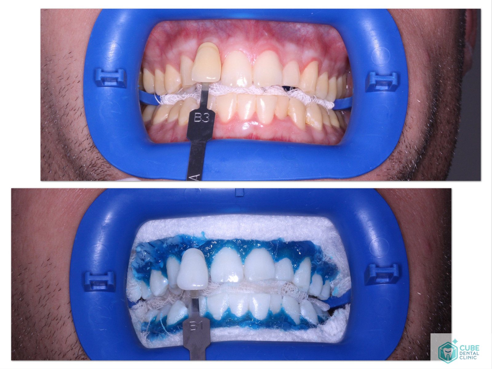 How to take good care of your teeth