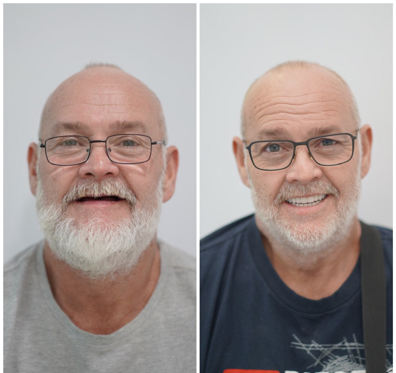 Résultat d’un traitement All-on-4 à la CUBE Dental Clinic