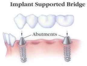 Different types of dental bridges