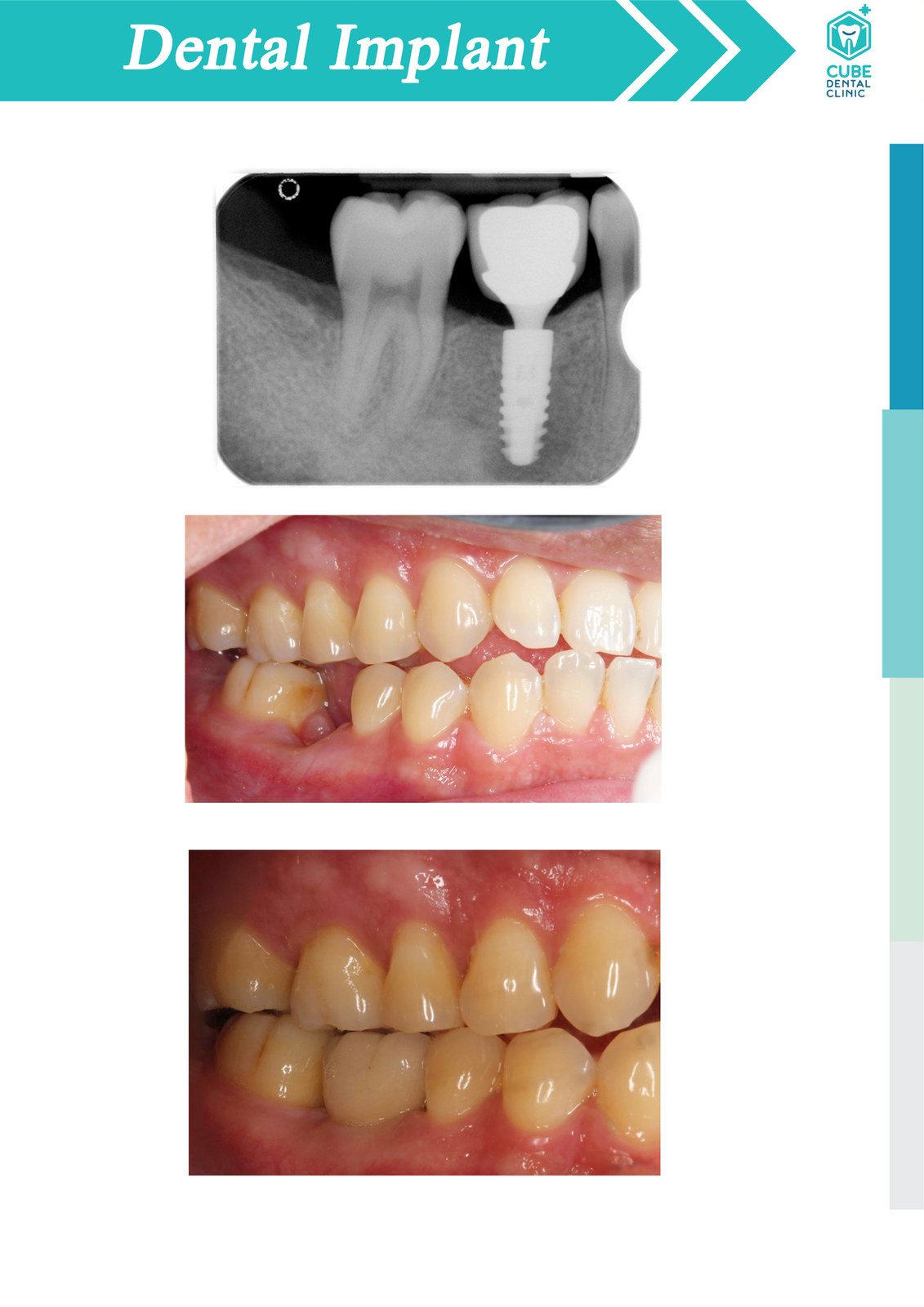 A dental implant case at CUBE Dental Clinic, shown on X-ray and in the mouth