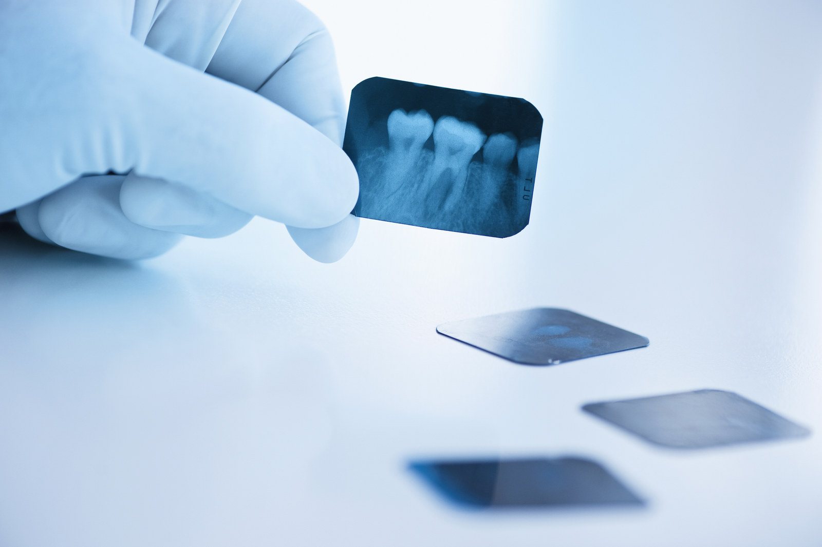 Röntgenbild zur Planung einer Veneer-Behandlung