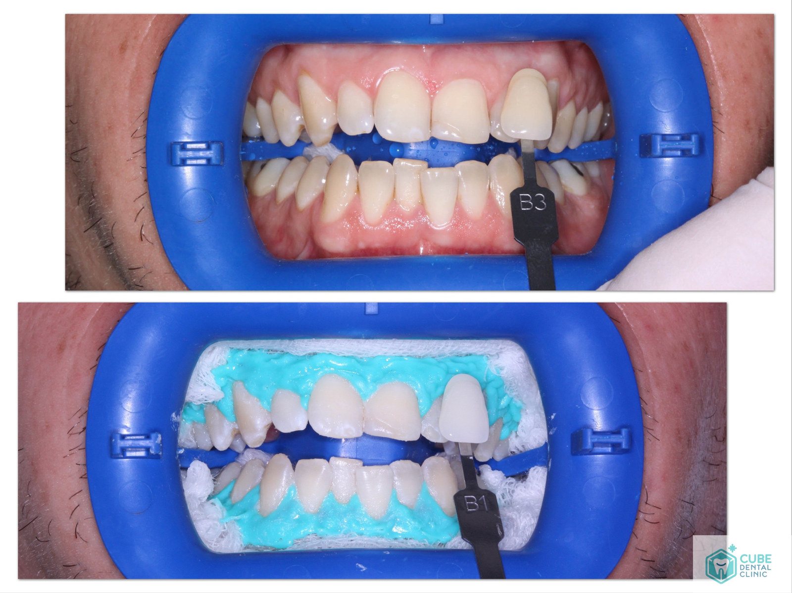 Do this and you will not feel pain after dental surgery