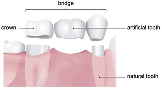 Diagram of a bridge spanning a gap between two prepared teeth