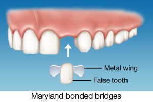 Maryland bonded bridge