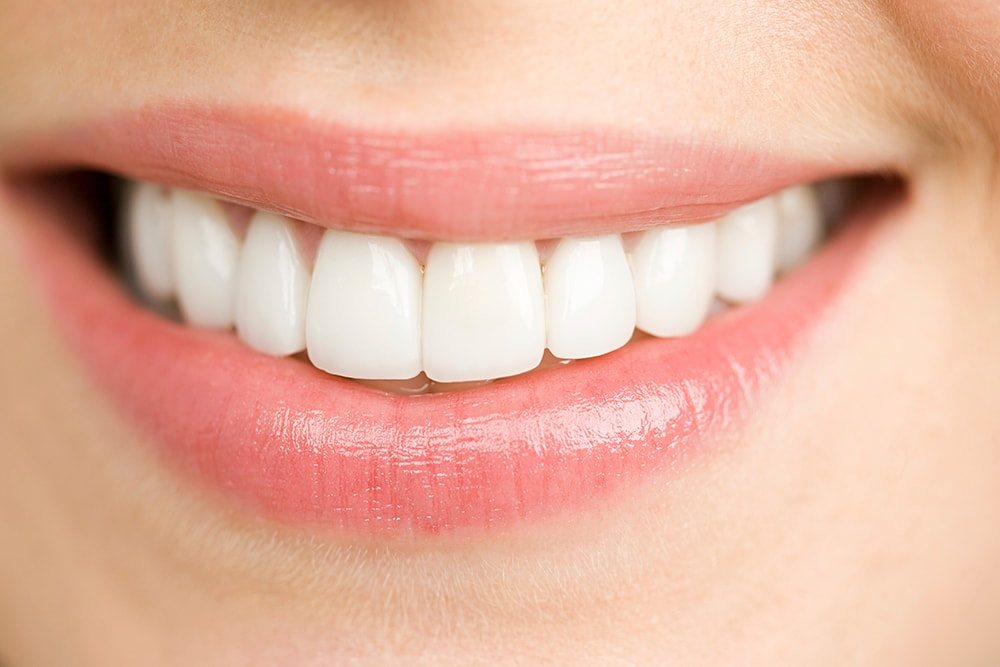 Darstellung eines auf einen Zahn geklebten Keramikveneers