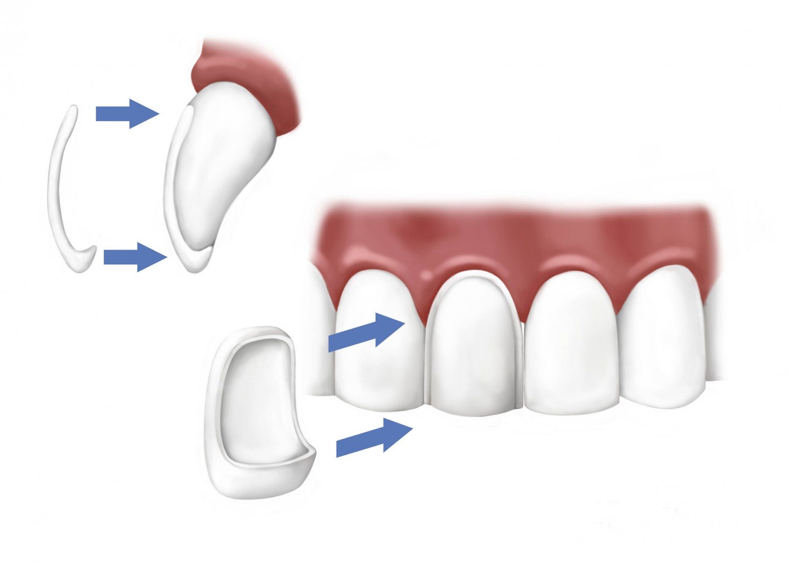 Veneers
