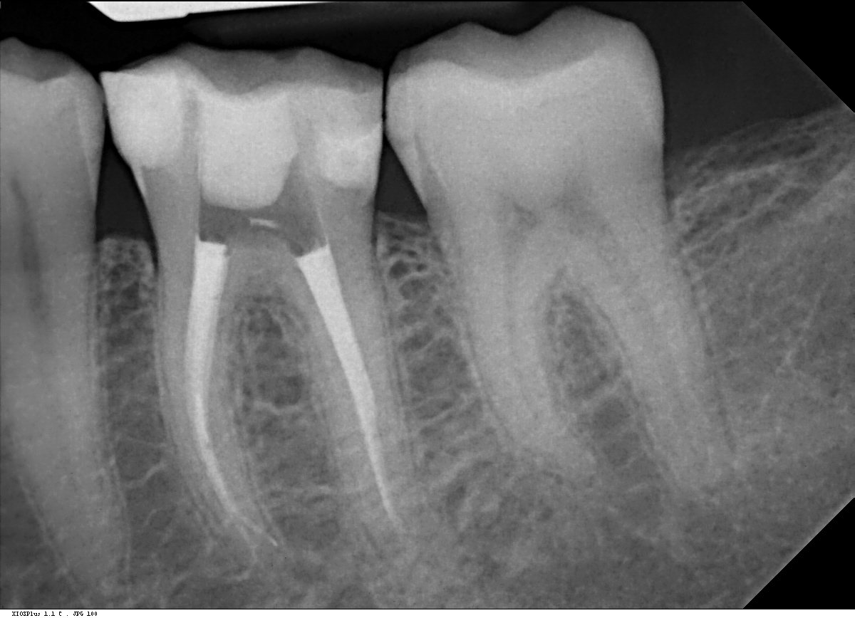 After root canal treatment, before the crown is fitted