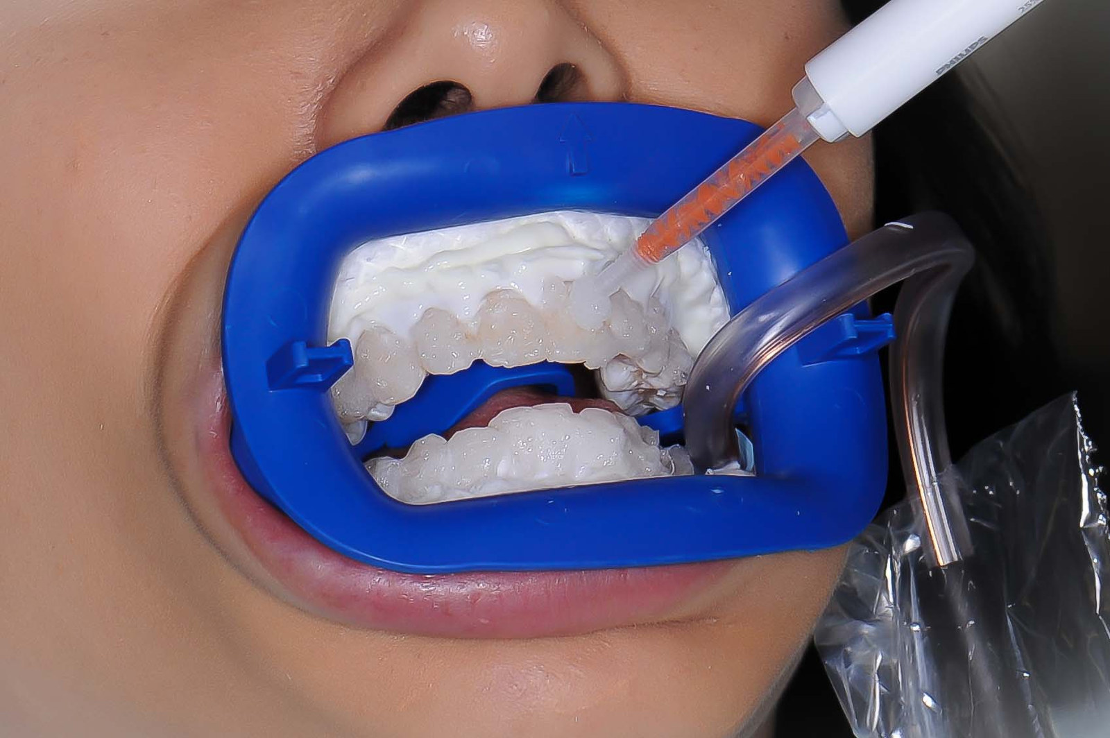Whitening lifts natural enamel only — restorations keep their original shade