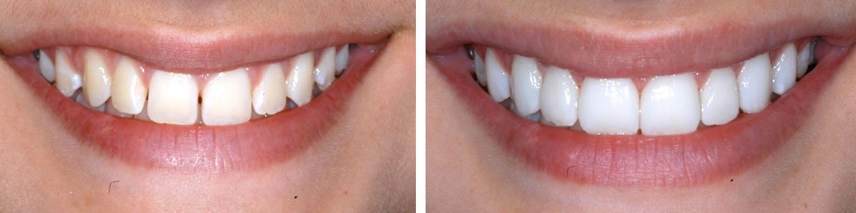 A porcelain veneer held against a shade guide
