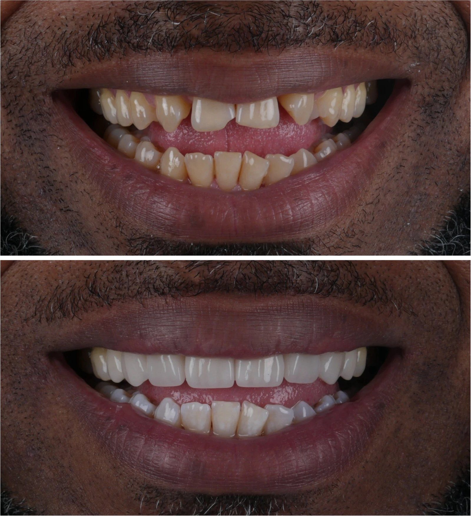 Vorher und nachher mit Veneers in der Praxis: vorher abgenutzte, lückige und verfärbte obere Frontzähne, nachher ein volleres, helleres Lächeln