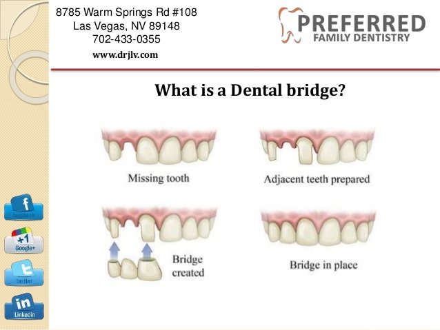 The process of fitting a dental bridge